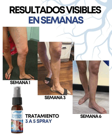 Piernas sin várices en 4 semanas, Spray + 12 Parches Gratis