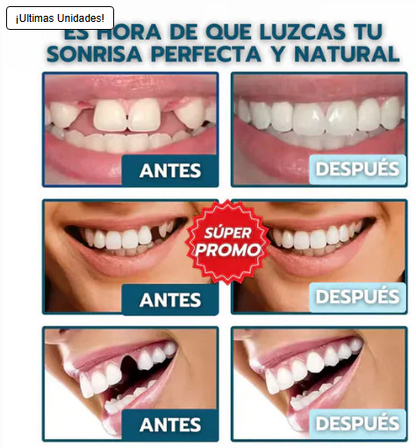Carillas Instant Smile™: ocultan manchas, espacios y torceduras en minutos, desde casa