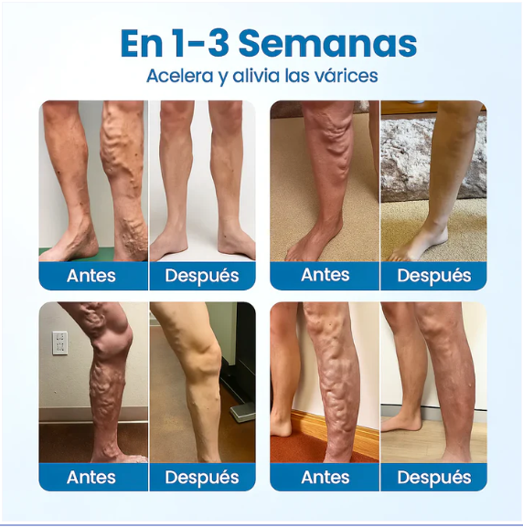 Piernas sin várices en 4 semanas, Spray + 12 Parches Gratis