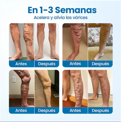 Piernas sin várices en 4 semanas, Spray + 12 Parches Gratis